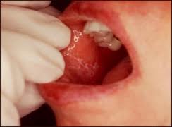 Boca- mucosa bucal