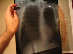 Radiografia de los pulmones